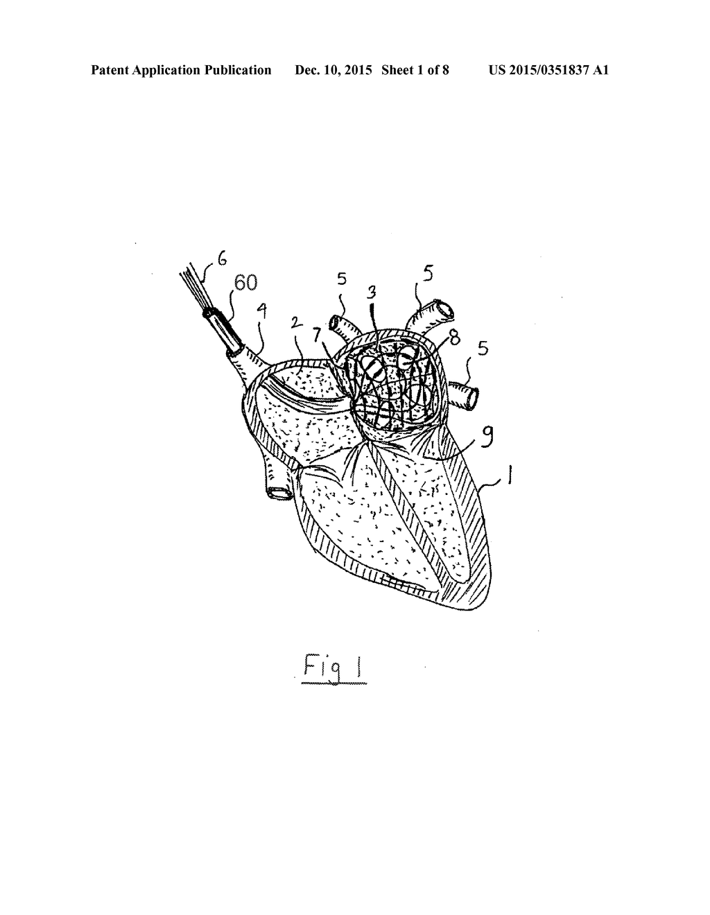 APPARATUS AND METHOD FOR INTRA-CARDIAC MAPPING AND ABLATION - diagram, schematic, and image 02