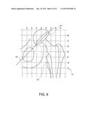 SURGICAL ALIGNMENT SYSTEM, APPARATUS AND METHOD OF USE diagram and image