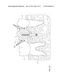 Parallel Alignment Apparatus for Facilitating Prosthodontic Restorations     and Method of Use diagram and image