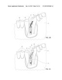 Parallel Alignment Apparatus for Facilitating Prosthodontic Restorations     and Method of Use diagram and image