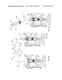 Dental Tool for Customizing Implants, System and Methods Thereof diagram and image