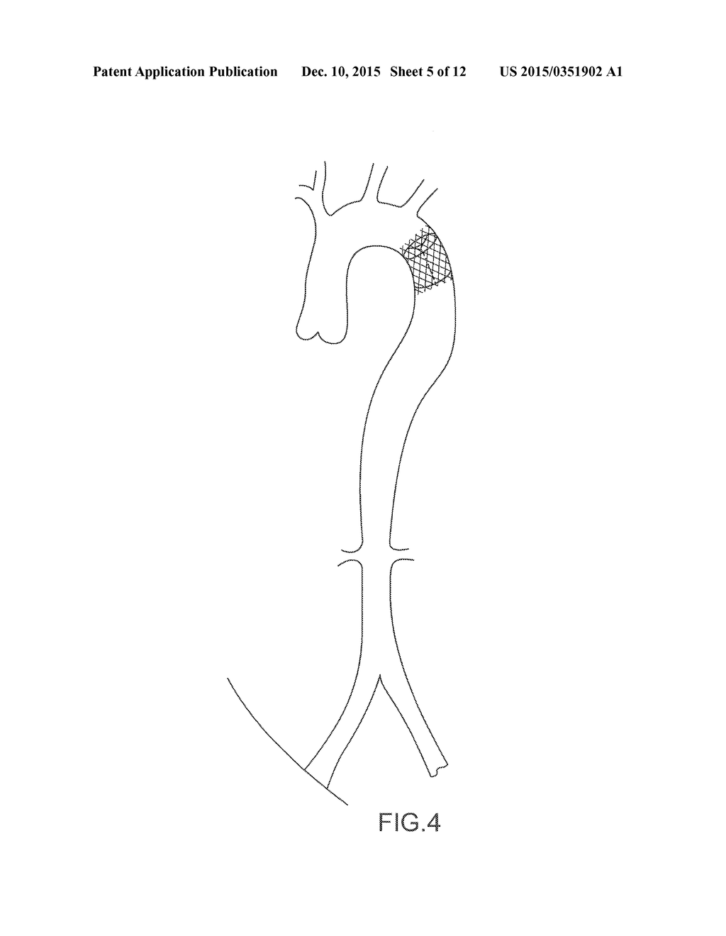 PERCUTANEOUSLY IMPLANTABLE REPLACEMENT HEART VALVE DEVICE AND METHOD OF     MAKING SAME - diagram, schematic, and image 06