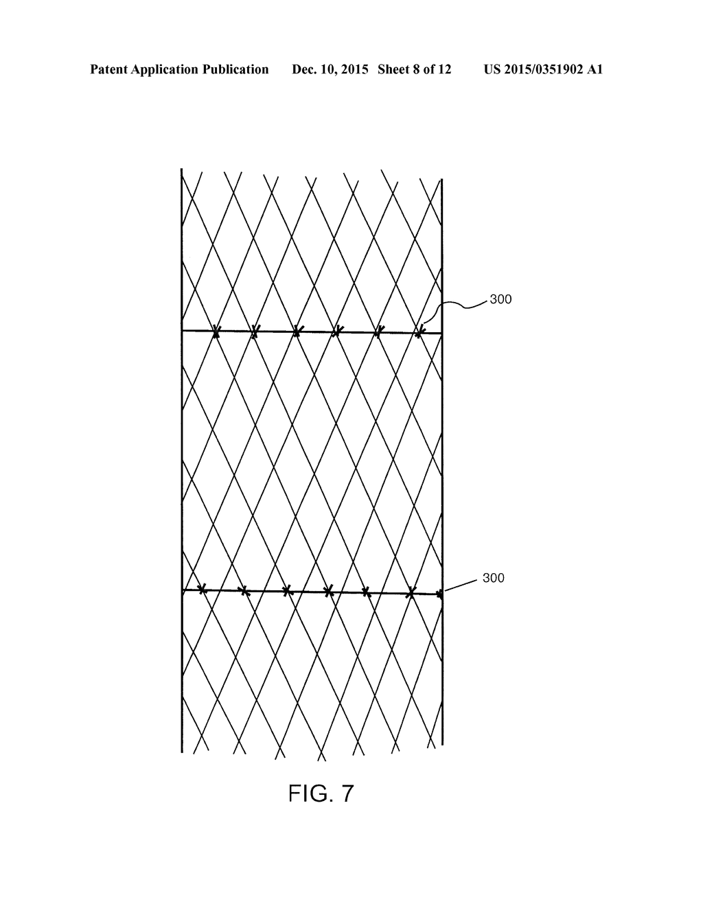 PERCUTANEOUSLY IMPLANTABLE REPLACEMENT HEART VALVE DEVICE AND METHOD OF     MAKING SAME - diagram, schematic, and image 09