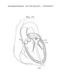 PROSTHETIC VALVE FOR REPLACING A MITRAL VALVE diagram and image