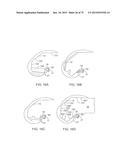 SYSTEMS AND METHODS FOR PROVIDING A FEMORAL COMPONENT diagram and image