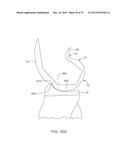 SYSTEMS AND METHODS FOR PROVIDING A FEMORAL COMPONENT diagram and image