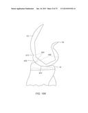 SYSTEMS AND METHODS FOR PROVIDING A FEMORAL COMPONENT diagram and image