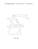 SYSTEMS AND METHODS FOR PROVIDING A FEMORAL COMPONENT diagram and image