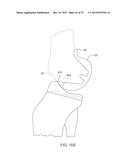 SYSTEMS AND METHODS FOR PROVIDING A FEMORAL COMPONENT diagram and image