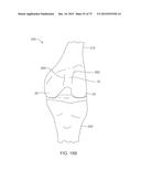 SYSTEMS AND METHODS FOR PROVIDING A FEMORAL COMPONENT diagram and image