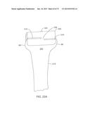 SYSTEMS AND METHODS FOR PROVIDING A FEMORAL COMPONENT diagram and image