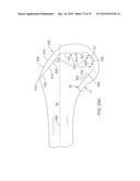 SYSTEMS AND METHODS FOR PROVIDING A FEMORAL COMPONENT diagram and image