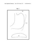 GASTRIC IMPLANT AND METHOD FOR USE OF SAME diagram and image