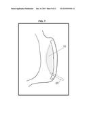 GASTRIC IMPLANT AND METHOD FOR USE OF SAME diagram and image