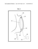 GASTRIC IMPLANT AND METHOD FOR USE OF SAME diagram and image