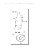 GASTRIC IMPLANT AND METHOD FOR USE OF SAME diagram and image