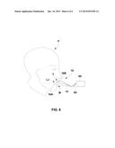 ORAL SECUREMENT APPLIANCE diagram and image