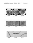 Bio-Absorbable Medicament-Eluting Ventilation Tube diagram and image