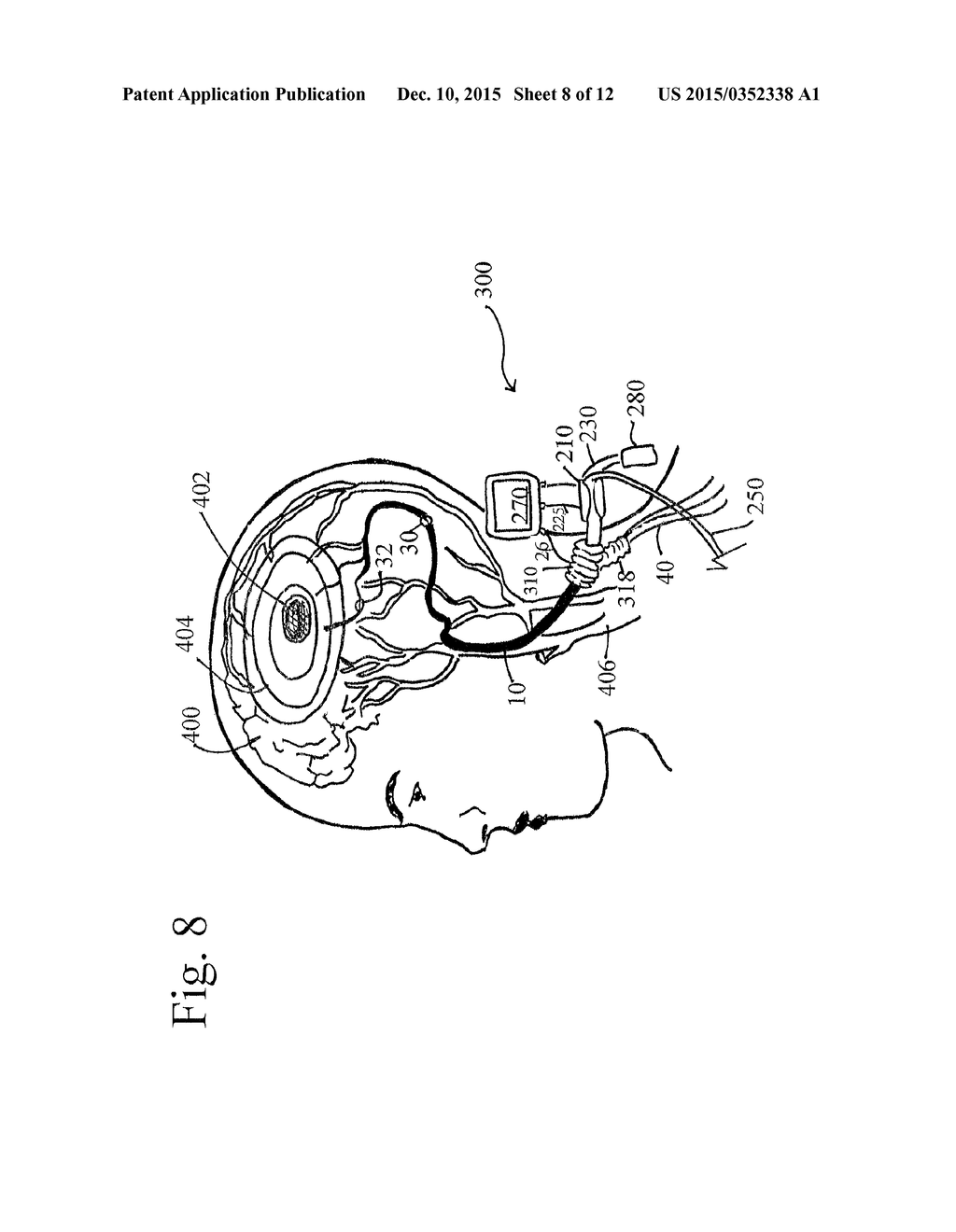 DEVICES, SYSTEMS, AND METHODS FOR AUTO-RETROPERFUSION OF THE CEREBRAL     VENOUS SYSTEM - diagram, schematic, and image 09