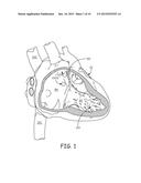 TINE FIXATION COMPONENTS FOR IMPLANTABLE MEDICAL DEVICES diagram and image