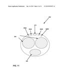 EXTERNAL STIMULATION THERAPY FOR DORSAL GENITAL NERVE STIMULATION diagram and image