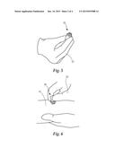 Borrelia Provocation Procedure Kit diagram and image