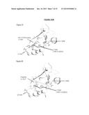 MARKERS FOR ACUTE LYMPHOBLASTIC LEUKEMIA diagram and image