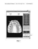 Dental Occlusion Analysis Tool diagram and image