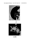 QUANTITATIVE PREDICTORS OF TUMOR SEVERITY diagram and image