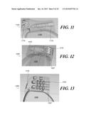 MODULAR ANTENNA FOR IMPLANTABLE MEDICAL DEVICE diagram and image