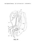 MINIMALLY INVASIVE SURGICAL SUTURING DEVICE FOR PAPILLARY MUSCLES AND     METHODS THEREOF diagram and image