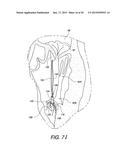 MINIMALLY INVASIVE SURGICAL SUTURING DEVICE FOR PAPILLARY MUSCLES AND     METHODS THEREOF diagram and image