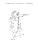 SYSTEMS AND METHODS FOR REMOVING OBSTRUCTIVE MATTER FROM BODY LUMENS AND     TREATING VASCULAR DEFECTS diagram and image