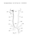 SYSTEMS AND METHODS FOR REMOVING OBSTRUCTIVE MATTER FROM BODY LUMENS AND     TREATING VASCULAR DEFECTS diagram and image