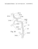 SYSTEMS AND METHODS FOR REMOVING OBSTRUCTIVE MATTER FROM BODY LUMENS AND     TREATING VASCULAR DEFECTS diagram and image