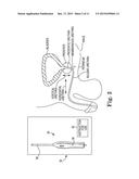 SURGICAL TOOL ADAPTED FOR IDENTIFYING AN INCISION SITE diagram and image