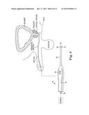 SURGICAL TOOL ADAPTED FOR IDENTIFYING AN INCISION SITE diagram and image