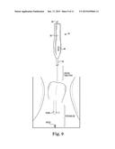 SURGICAL TOOL ADAPTED FOR IDENTIFYING AN INCISION SITE diagram and image