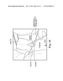 SURGICAL TOOL ADAPTED FOR IDENTIFYING AN INCISION SITE diagram and image