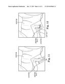 SURGICAL TOOL ADAPTED FOR IDENTIFYING AN INCISION SITE diagram and image