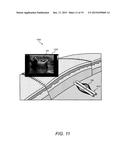 ULTRASOUND-DETECTABLE MARKERS, ULTRASOUND SYSTEM, AND METHODS FOR     MONITORING VASCULAR FLOW AND PATENCY diagram and image