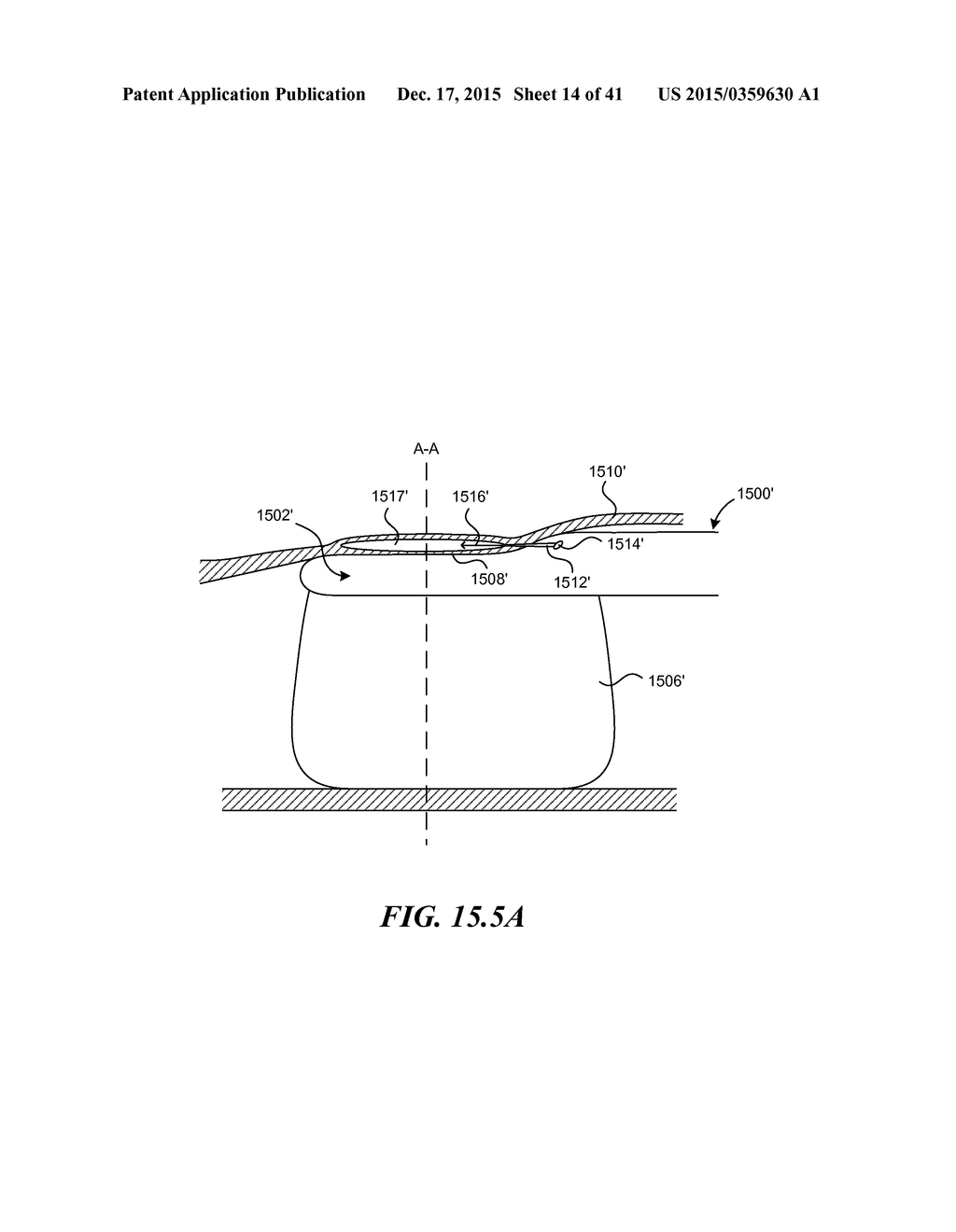 SYSTEMS AND METHODS FOR ENDOLUMINAL VALVE CREATION - diagram, schematic, and image 15