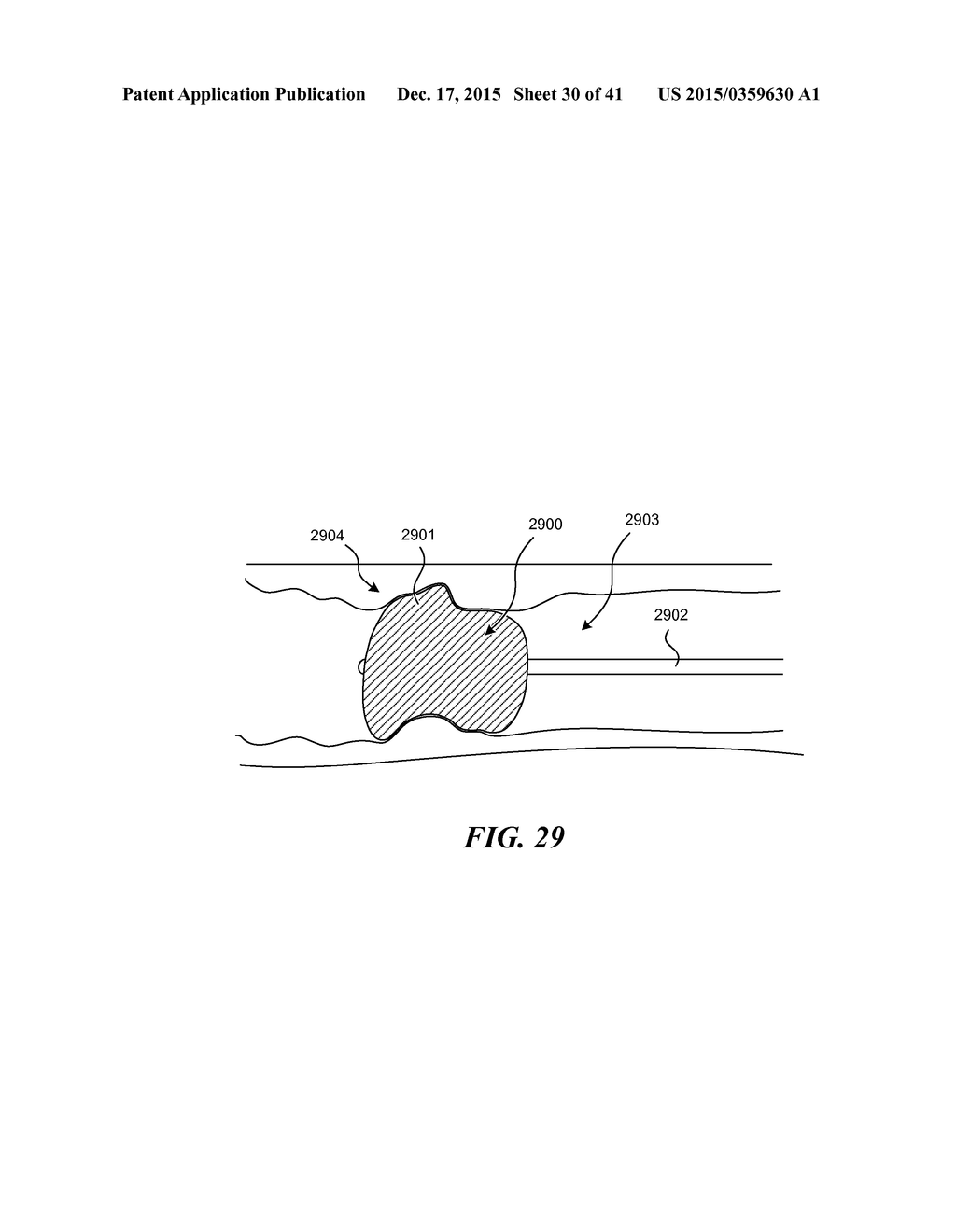 SYSTEMS AND METHODS FOR ENDOLUMINAL VALVE CREATION - diagram, schematic, and image 31