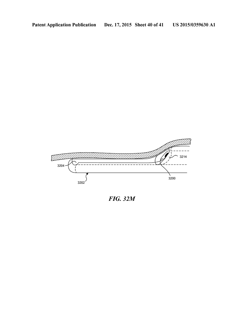 SYSTEMS AND METHODS FOR ENDOLUMINAL VALVE CREATION - diagram, schematic, and image 41