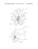 INTERSPINOUS IMPLANTS diagram and image