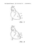 Extracellular Matrix Constructs for Treating Damaged Biological Tissue diagram and image