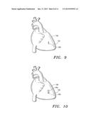 Extracellular Matrix Constructs for Treating Damaged Biological Tissue diagram and image