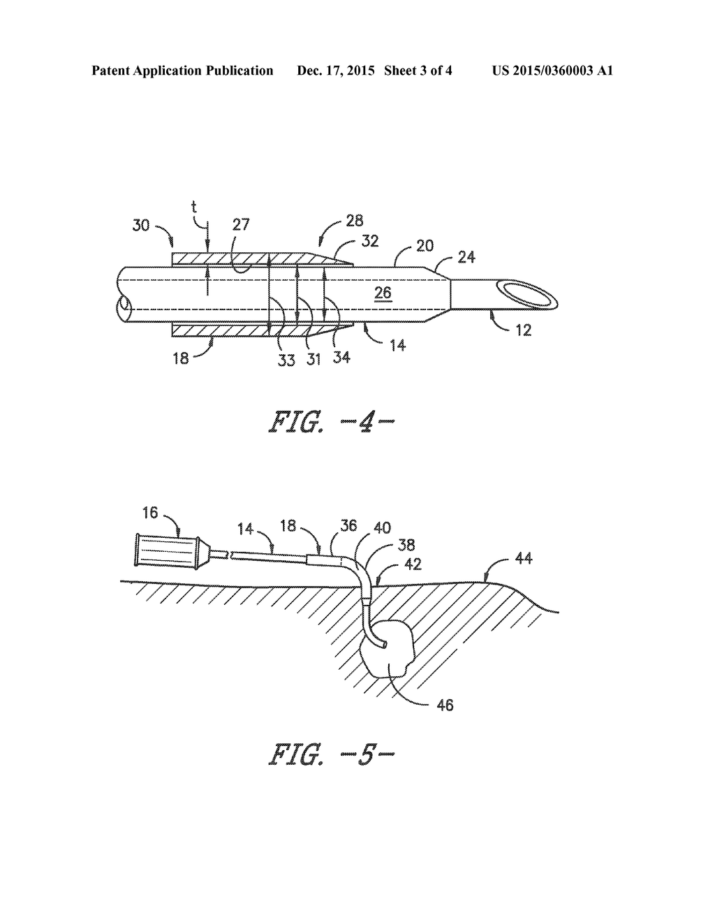 Over-the-Needle Catheter Sleeve - diagram, schematic, and image 04