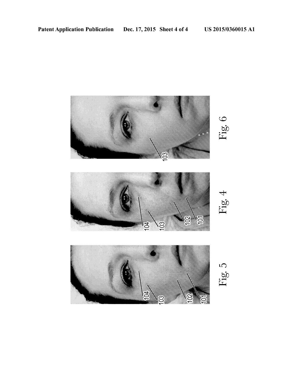 APPARATUS AND METHODS FOR MODIFYING KERATINOUS SURFACES - diagram, schematic, and image 05