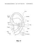 Transcutaneous Electrostimulator and Methods for Electric Stimulation diagram and image